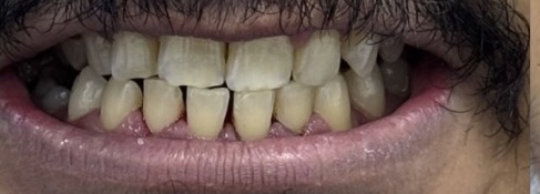 Teeth cleaning & polishing after