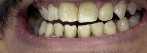 Teeth cleaning & polishing before