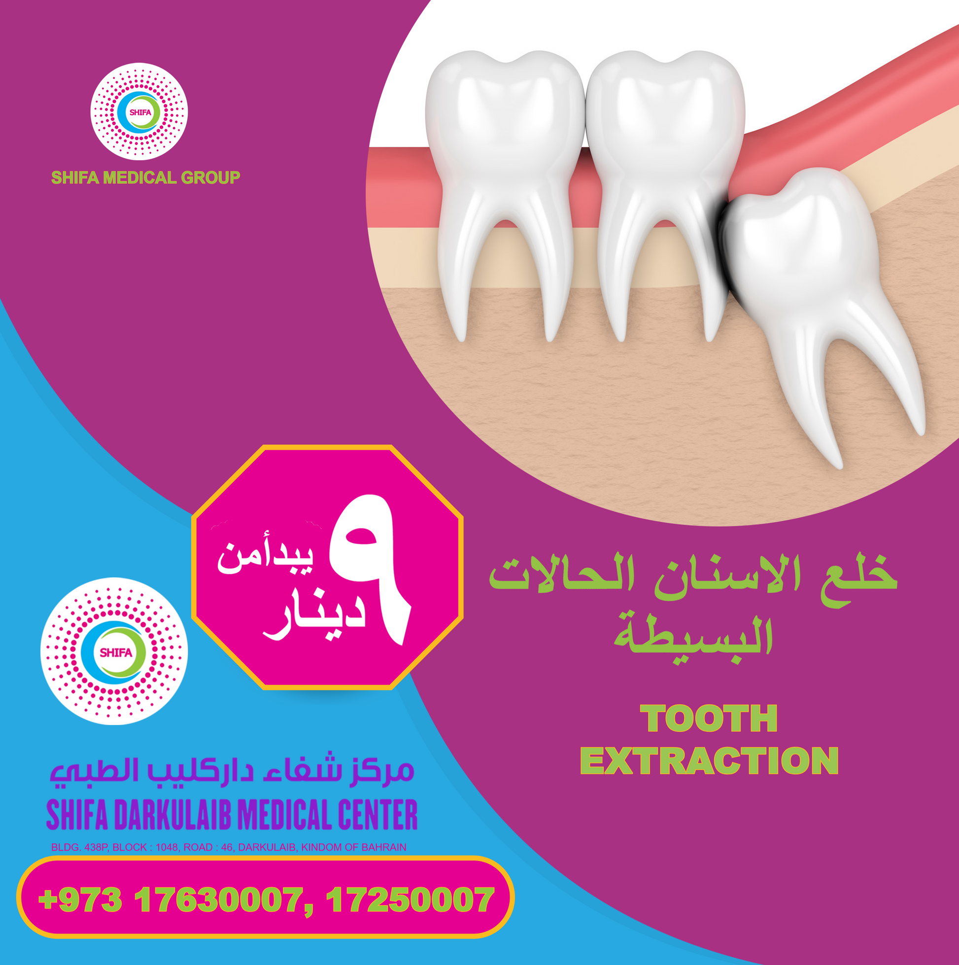 Simple Tooth Extraction