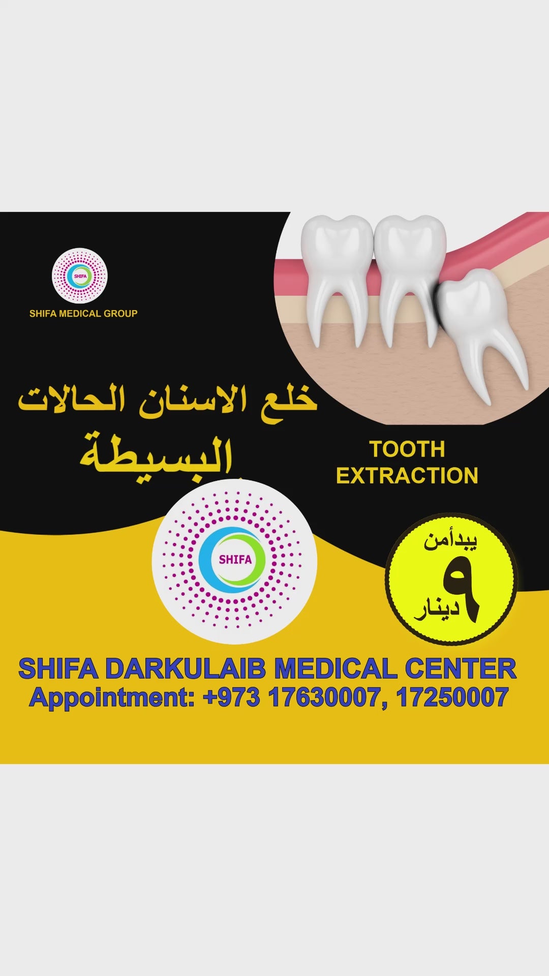 Simple Tooth Extraction
